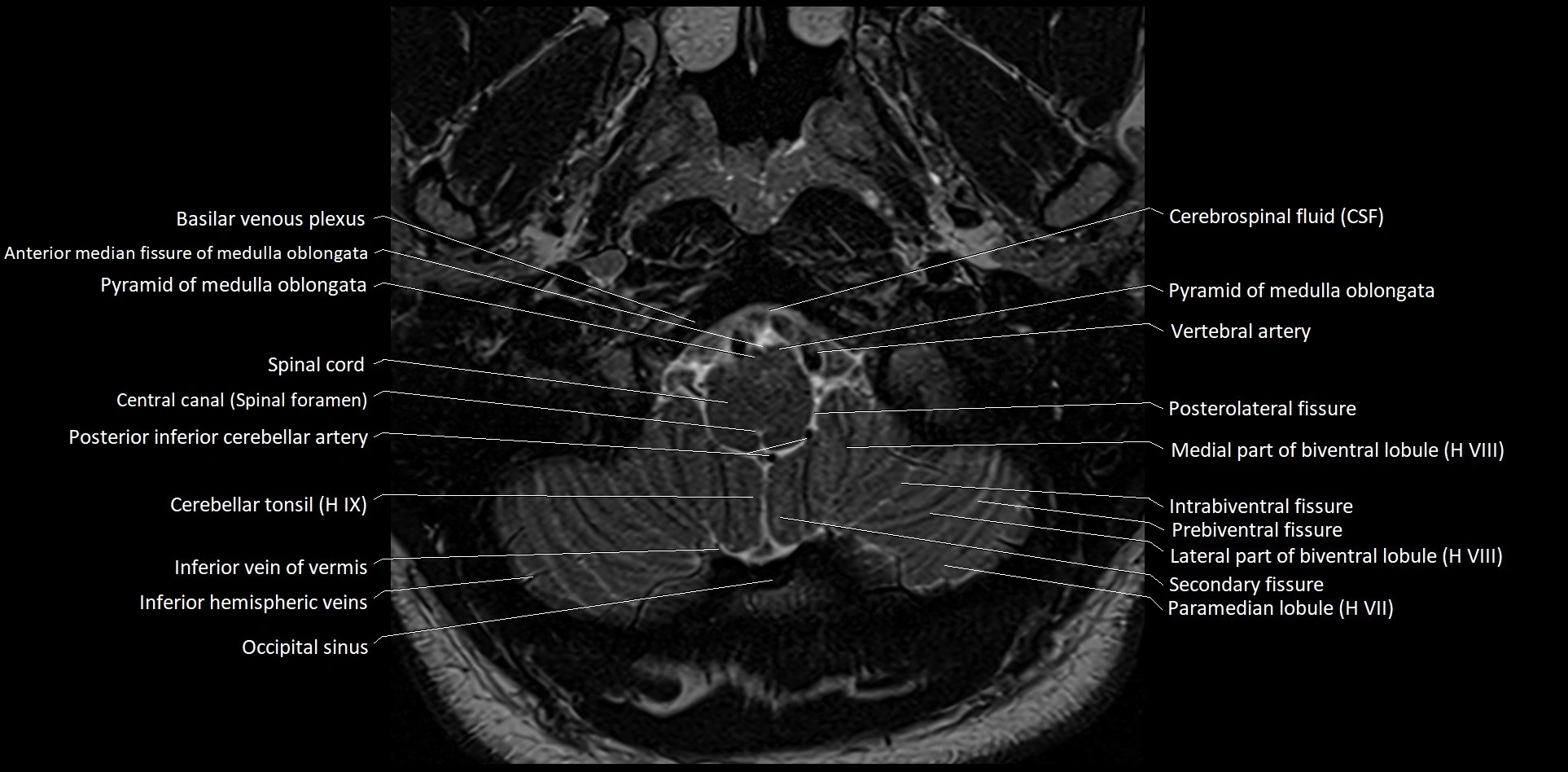 MRI Cerebellar anatomy High-resolution labelled 3T MRI image 3.webp